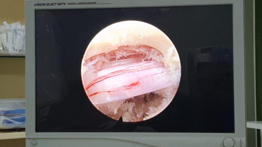 Endoscopic spine surgery