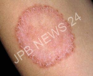 Read more about the article फंगल संक्रमण को रोकने के लिए कौन सा उपचार करें। – Which treatment to prevent fungal infection.