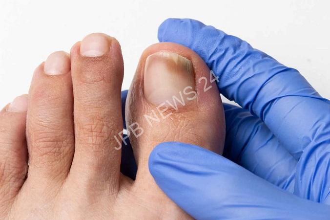 Read more about the article बरसात में नाखून हो रहे हैं सड़ने-गलने तो अपनाएं ये उपाय, फंगल इंफेक्शन को बढ़ने से रोकने में मिलेगी राहत – If your nails are rotting in the rainy season, then adopt these remedies, you will get relief in preventing fungal infection from growing